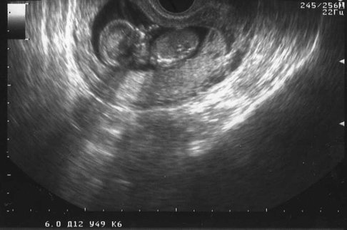 В ожидании Дауна